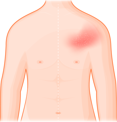 몸통의 한쪽 피부에 붉음과 물집이 생긴 설명도