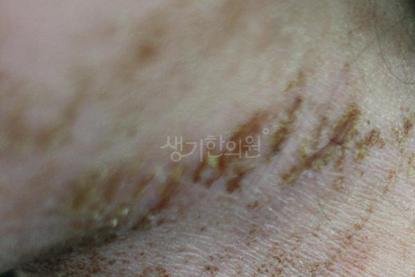 아토피 치료 전 사진 · 생기한의원 청주점